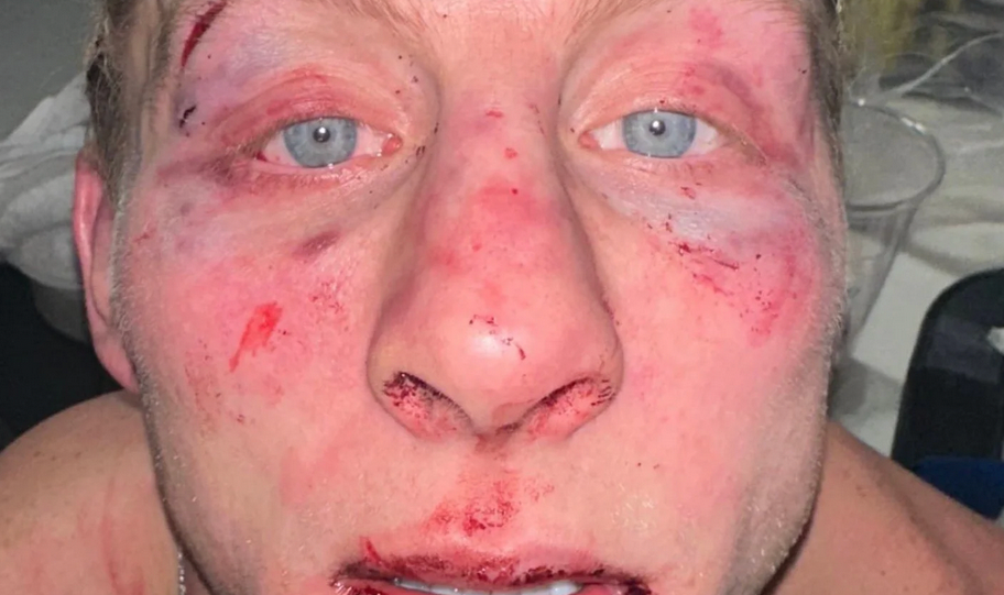 Best of the Best: MMAmania.com’s UFC/MMA week in review – Paddy Piblett’s mangled face was brutal Best of the Best: MMAmania.com’s UFC/MMA week in review – Paddy Piblett’s mangled face was brutal